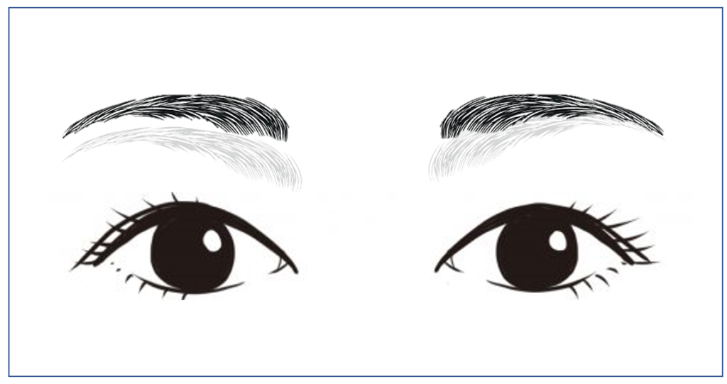 眉頭　下がり対策